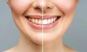 How To Make Your Teeth Whiter In 7 Days