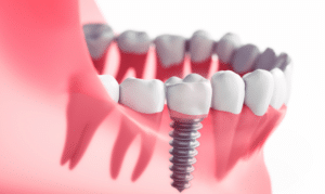 How to Maintain Your Dental Implants for Long-Term Success