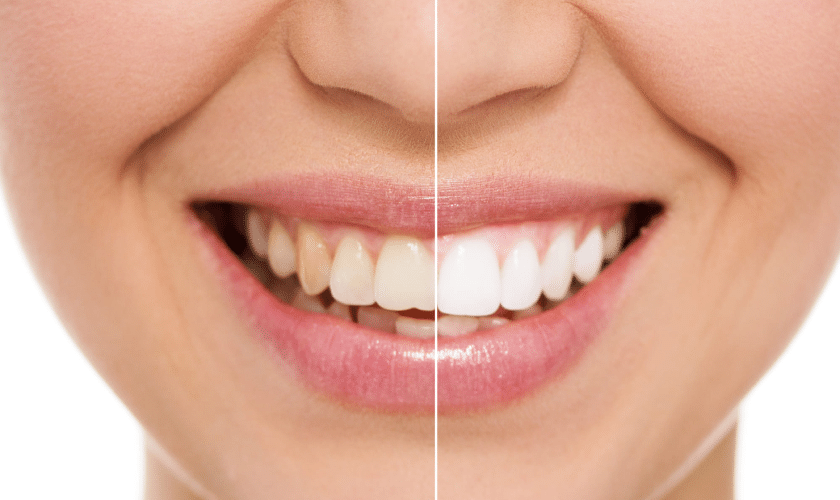 Whitening Before After