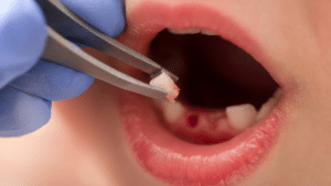 The Ultimate Guide To What You Shouldn’t Eat Or Drink After Tooth Extraction