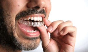 What to do if your Invisalign Aligner is Cutting Your Gums