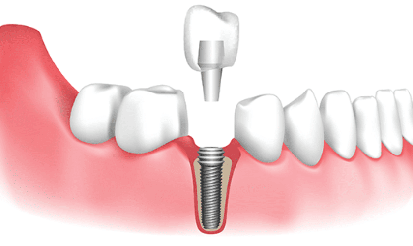 The Benefits of Dental Implants A Closer Look at Modern Tooth Replacement