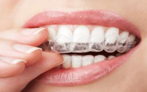 Unveiling Invisalign The Clear Path to Your Dream Smile
