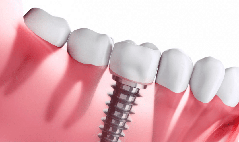 The Ultimate Guide to Dental Implants Benefits and What to Expect