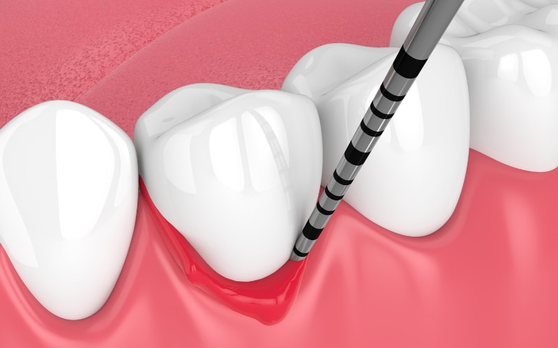 get dental implants if you have gum disease