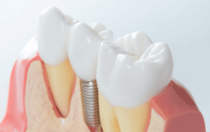 what know before getting dental implant