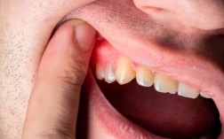 when to act for receding gums