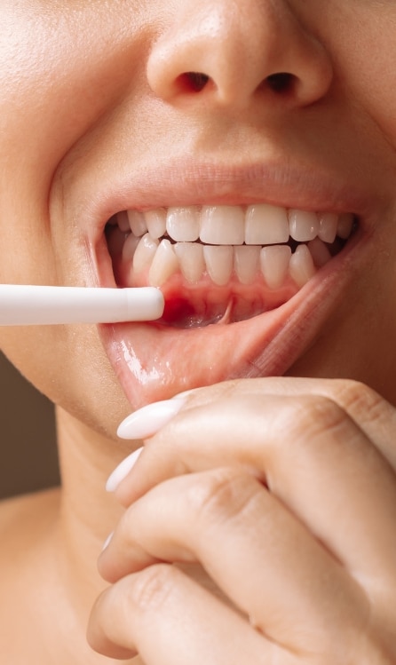Receding Gums