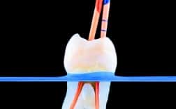 assessing the success of root canal