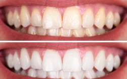 does aging effect tooth whitening results