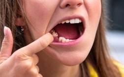 Why You Shouldn’t Ignore the Need for a Tooth Extraction
