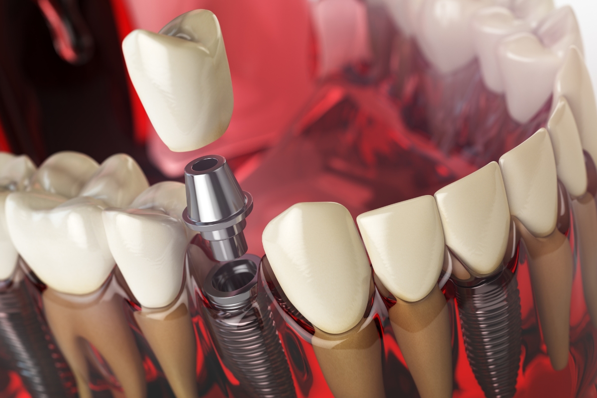 Dental Implants Phoenix